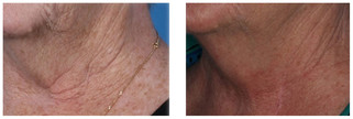 Mezoterapia - odmładzanie i rewitalizacja skóry przed i po zabiegu