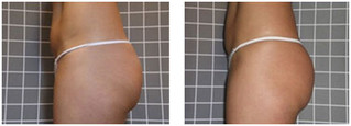 Modelowanie sylwetki i usuwanie cellulitu (lipomasaż) przed i po zabiegu