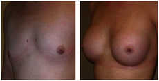 Operacje plastyczne piersi przed i po zabiegu