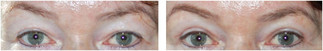 Operacje plastyczne powiek przed i po zabiegu