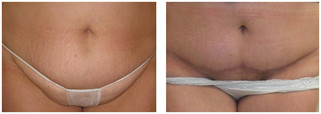 Plastyka brzucha przed i po zabiegu