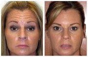 Usuwanie zmarszczek botoksem przed i po zabiegu
