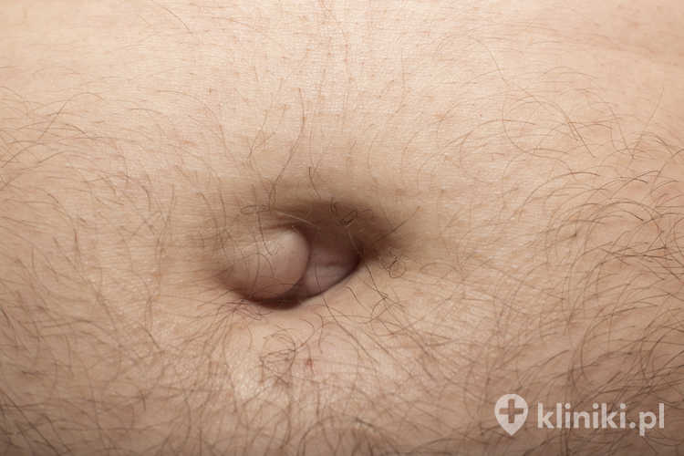 Diagnoza przepukliny obejmuje ocenę widocznego lub wyczuwalnego uwypuklenia