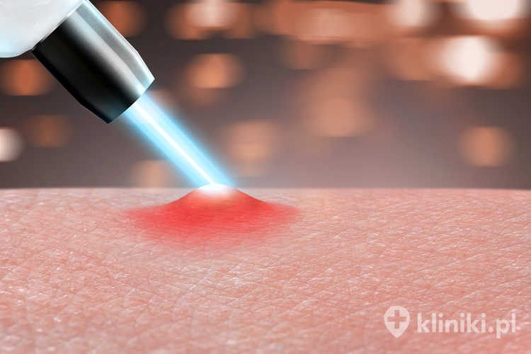 Laserowe leczenie trądziku może wspomagać redukcję wybranych zmian zapalnych