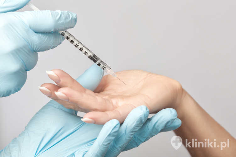 Leczenie nadpotliwości dłoni toksyną botulinową