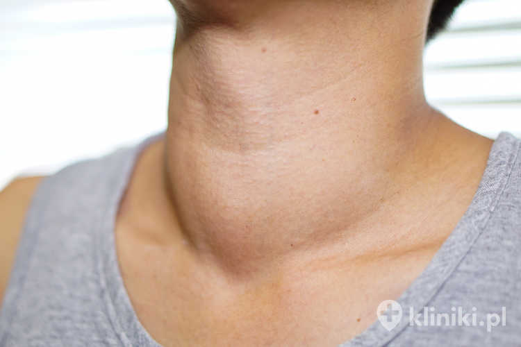 W przypadku zakażenia torbiel boczna szyi może ulec powiększeniu i stać się bolesna