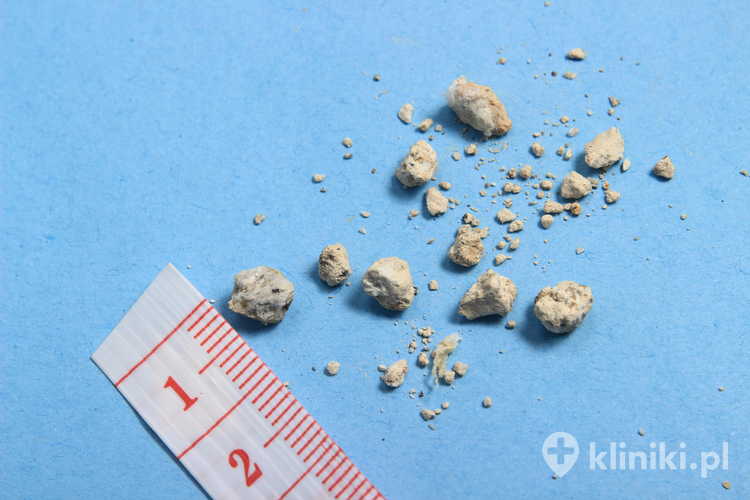 Metody usuwania kamieni nerkowych dobierane są indywidualnie, w zależności od wielkości, składu i położenia złogów.