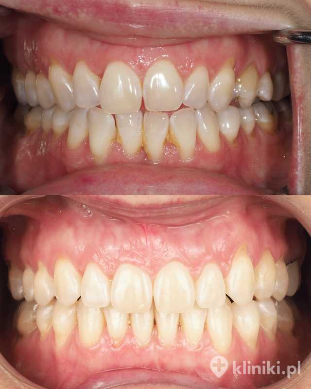 Aparat ortodontyczny Clear Aligner - zdjęcia przed i po | Kliniki.pl