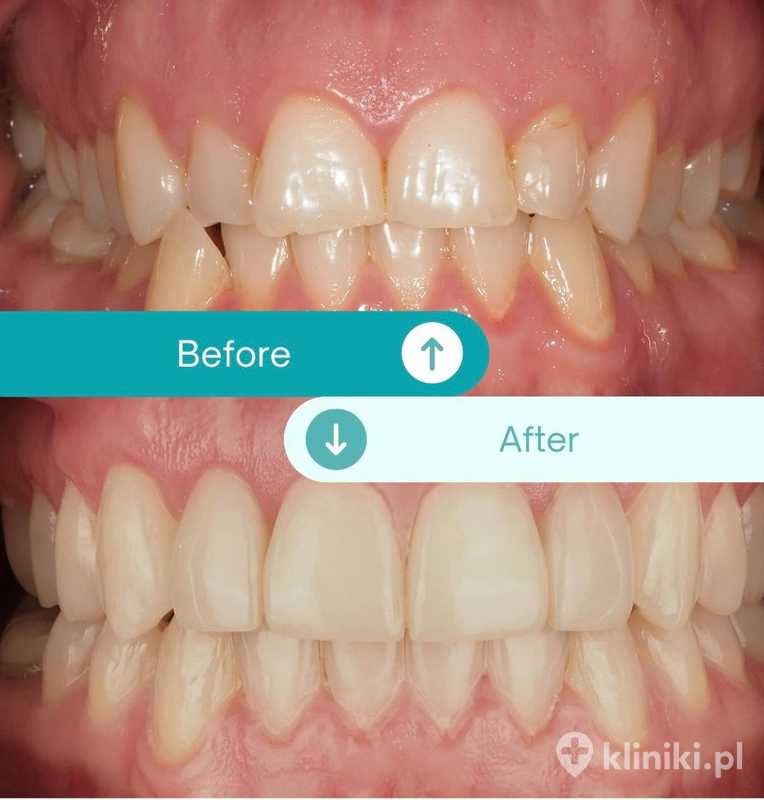 Aparat ortodontyczny Clear Aligner - zdjęcia przed i po | Kliniki.pl