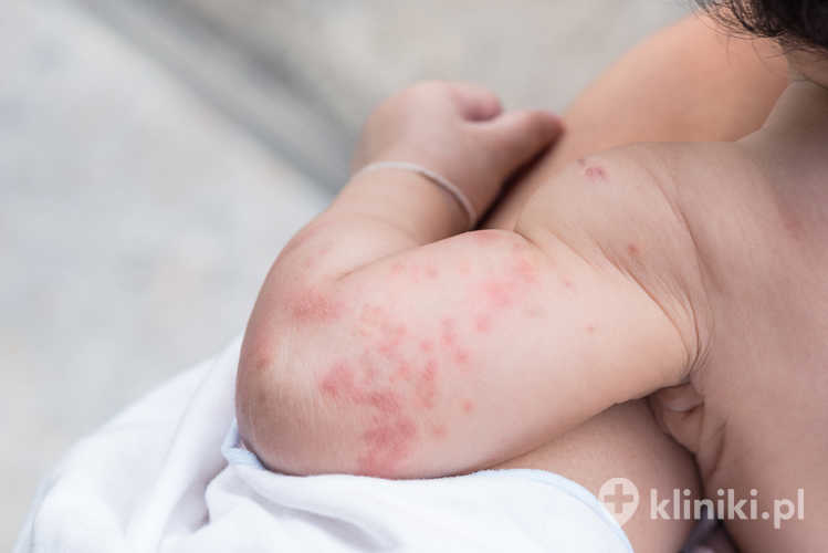 Leczenie prowadzone przez alergologa pomaga ograniczyć objawy i kontakt z alergenami