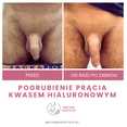 Chirurgia plastyczna męskich narządów płciowych przed i po zabiegu