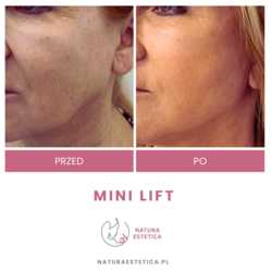 Lifting operacyjny przed i po zabiegu