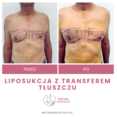 Liposukcja - leczenie ginekomastii przed i po zabiegu