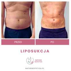 Liposukcja - odsysanie tłuszczu przed i po zabiegu