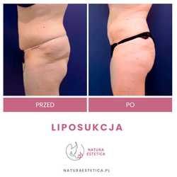 Liposukcja - odsysanie tłuszczu przed i po zabiegu