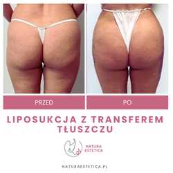 Liposukcja - odsysanie tłuszczu przed i po zabiegu