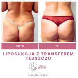 Liposukcja - odsysanie tłuszczu przed i po zabiegu