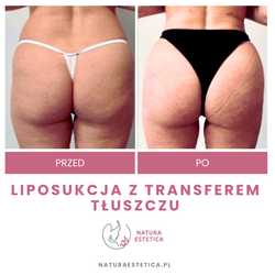 Liposukcja - odsysanie tłuszczu przed i po zabiegu