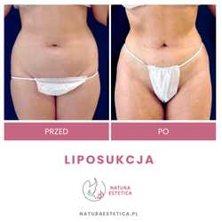 Liposukcja - odsysanie tłuszczu przed i po zabiegu