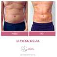 Liposukcja - odsysanie tłuszczu przed i po zabiegu
