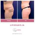 Liposukcja - odsysanie tłuszczu przed i po zabiegu