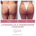 Liposukcja - odsysanie tłuszczu przed i po zabiegu