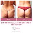 Liposukcja - odsysanie tłuszczu przed i po zabiegu