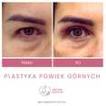 Operacje plastyczne powiek przed i po zabiegu