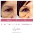 Operacje plastyczne powiek przed i po zabiegu