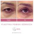Plastyka chirurgiczna powiek górnych przed i po zabiegu