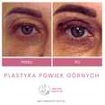 Plastyka chirurgiczna powiek górnych przed i po zabiegu