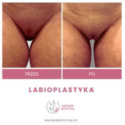 Plastyka warg sromowych mniejszych / większych przed i po zabiegu