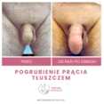 Powiększanie penisa przed i po zabiegu