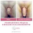 Powiększanie penisa kwasem hialuronowym przed i po zabiegu