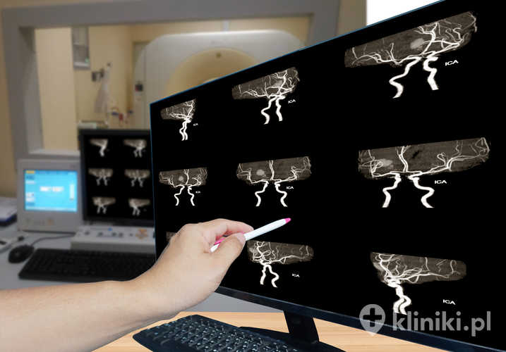 Rezonans magnetyczny barku dokładnie obrazuje ścięgna, mięśnie i pozostałe struktury stawu