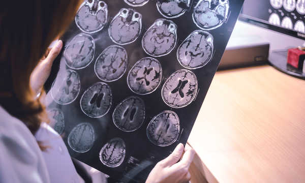 Rezonans magnetyczny przysadki mózgowej dokładnie obrazuje gruczoł i otaczające go struktury