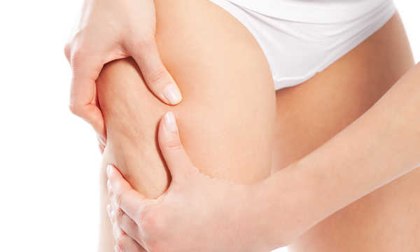 Pacjentka przed lipolizą iniekcyjną