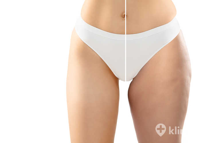 Laserowa liposukcja ud