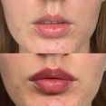 Powiększanie ust kwasem hialuronowym przed i po zabiegu