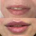 Powiększanie ust kwasem hialuronowym przed i po zabiegu