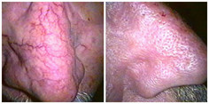 Dermatochirurgia przed i po zabiegu