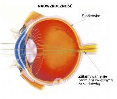 Nadwzroczność - rysunek poglądowy