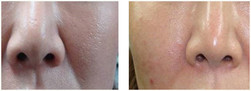 Twarz - odmładzanie skóry mezoterapią mikroigłową przed i po zabiegu
