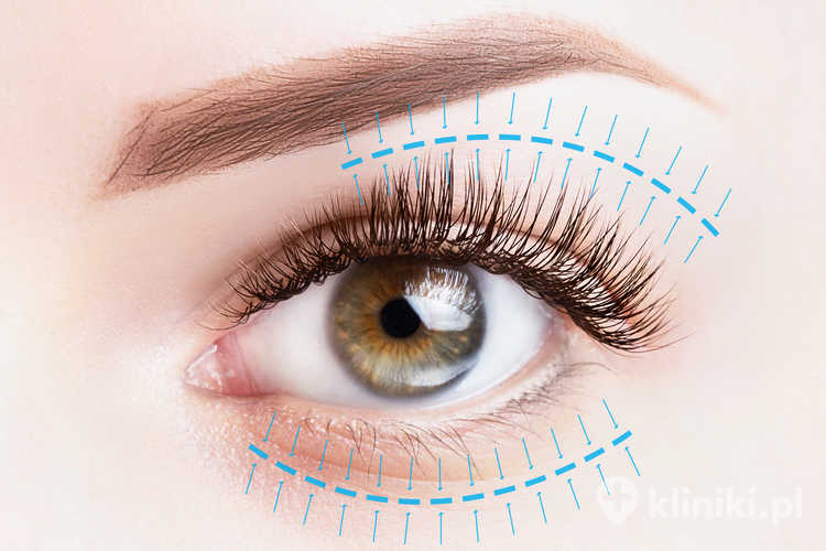 Blefaroplastyka powiek