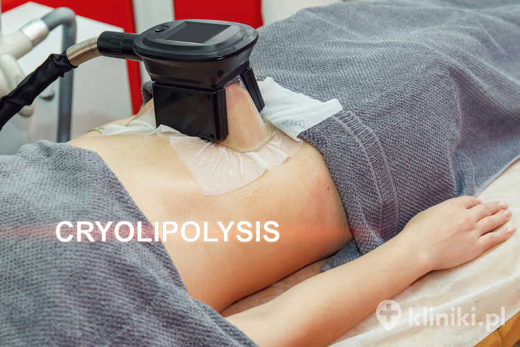 Kriolipoliza coolsculpting na brzuch