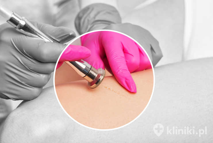 Dermabrazja usuwająca tatuaż