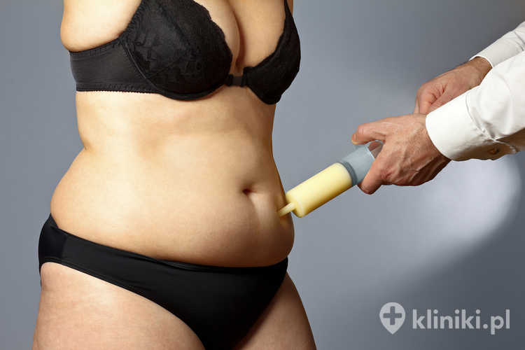W Polsce liposukcję Vaser LIPO HD wykonują doświadczeni specjaliści