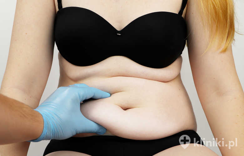 Liposukcja klasyczna brzucha i talii wymaga indywidualnej kwalifikacji lekarskiej