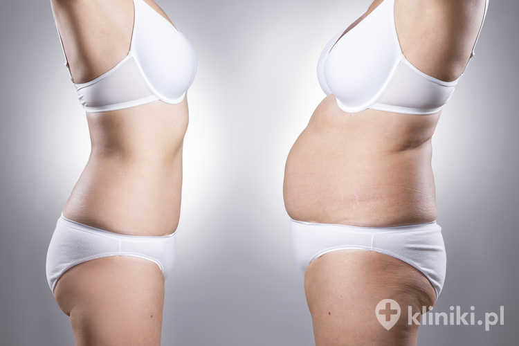 Liposukcja laserowej Slim Lipo 3D - stan przed i po zabiegu