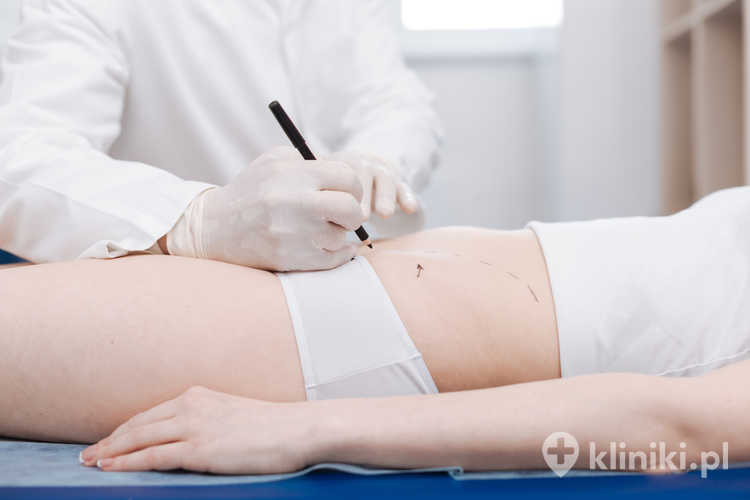 Przygotowanie do liposukcji wibracyjnej brzucha